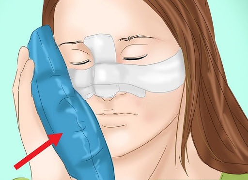 Chăm sóc mũi sau khi nâng