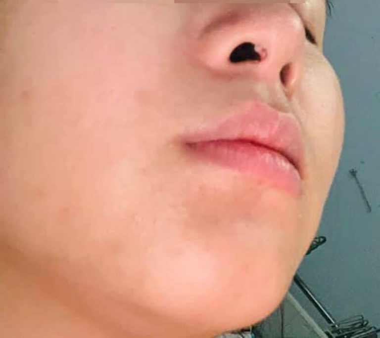 Nâng mũi bị lòi sụn trong mũi