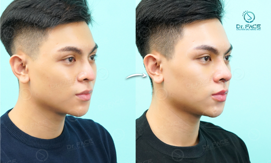 Trước và sau khi nâng mũi nam giới