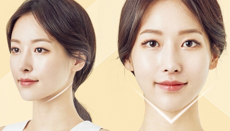 Độn cằm bao lâu thì đẹp