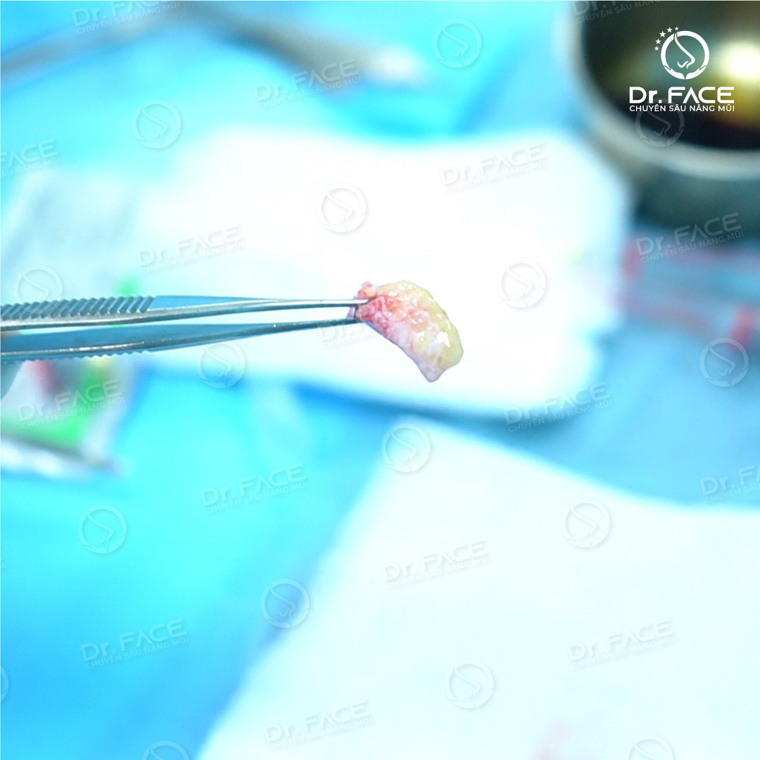 Nâng mũi cấu trúc đệm trung bì mỡ đầu mũi