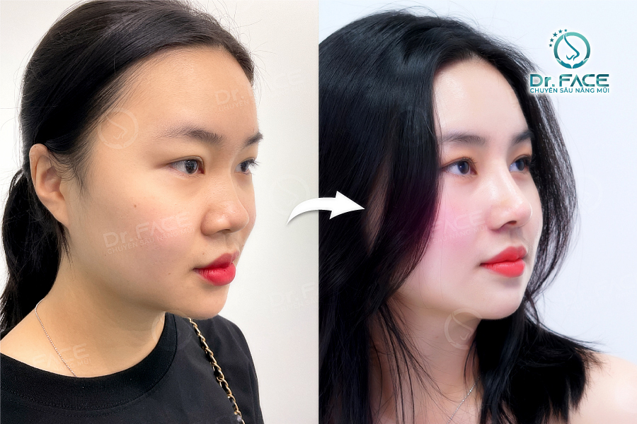 chăm sóc sau nâng mũi tại nhà