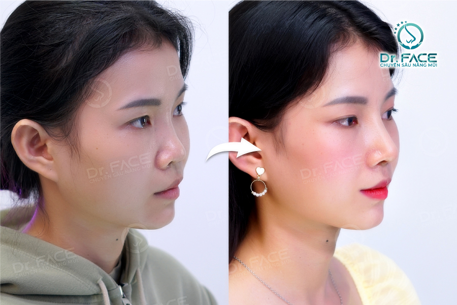DrFace bị phốt